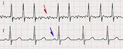 atrijska fibrilacija EKG