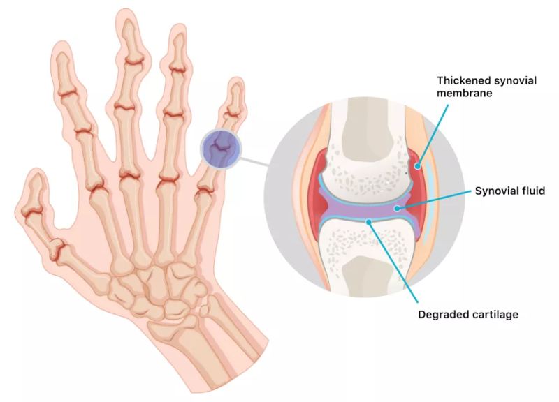 pritisak na zglobovima pripravci za liječenje artroze i osteohondroze