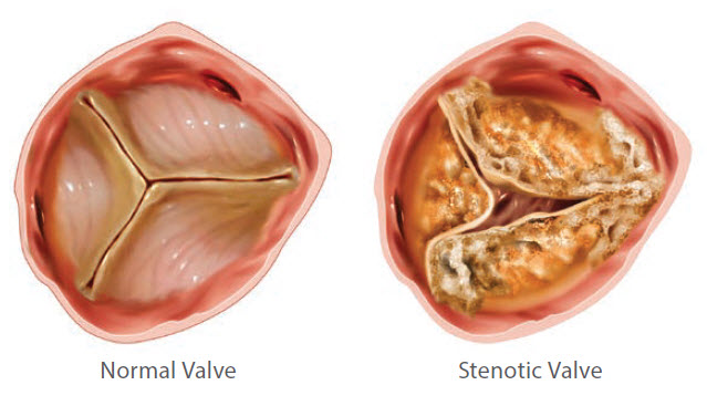 stenoza aortnog zaliska