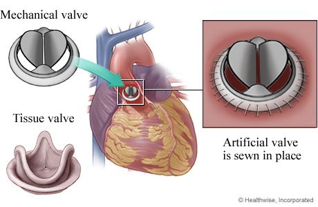 operacija zamene aortnog zaliska