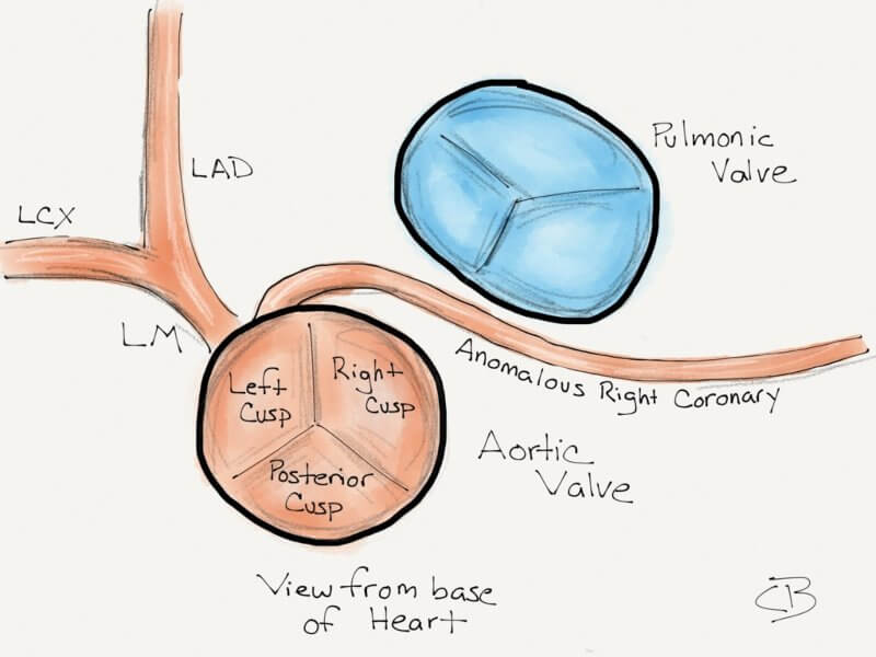 anomalna desna koronarna arterija