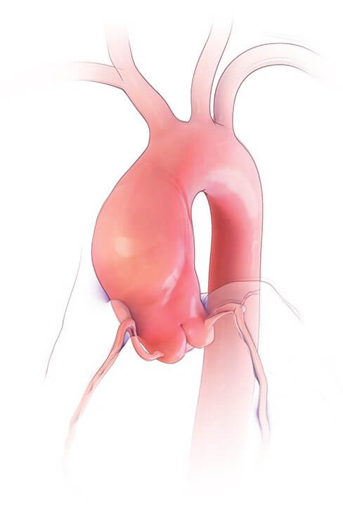 aneurizma aorte