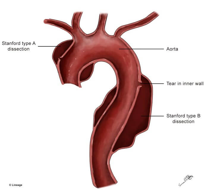 disekcija aorte