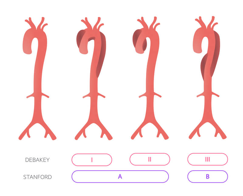 klasifikacija disekcije aorte