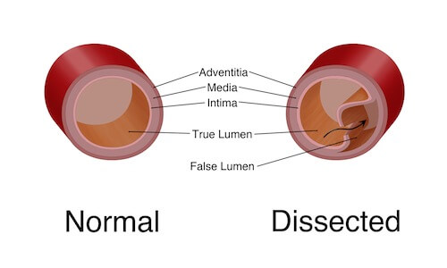 mehanizam nastanka disekcije aorte