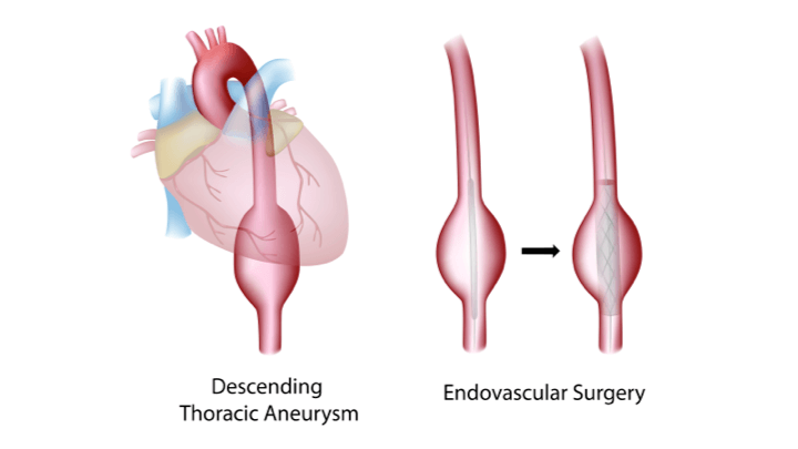aneurizma grudne aorte