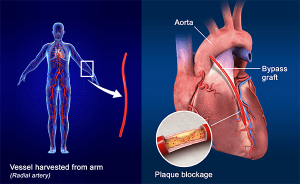 Coronary Artery Bypass Graft CABG radial artery