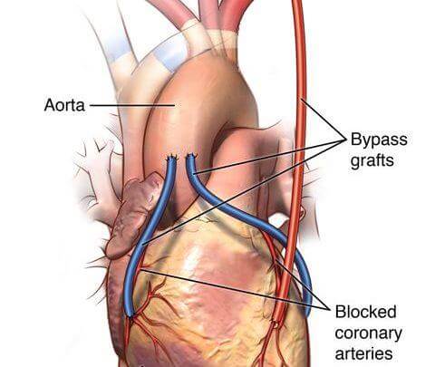bajpas srca hirurgija