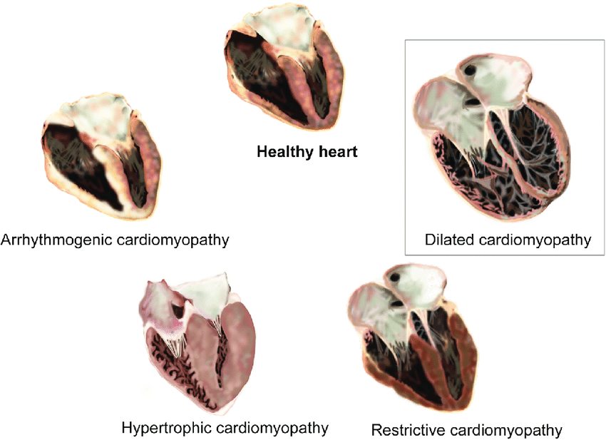 kardiomiopatija vrste i podela