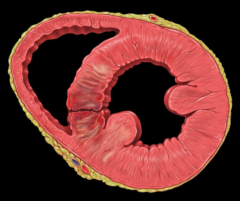 komplikacija srčanog udara - ventrikularni septalni defekt