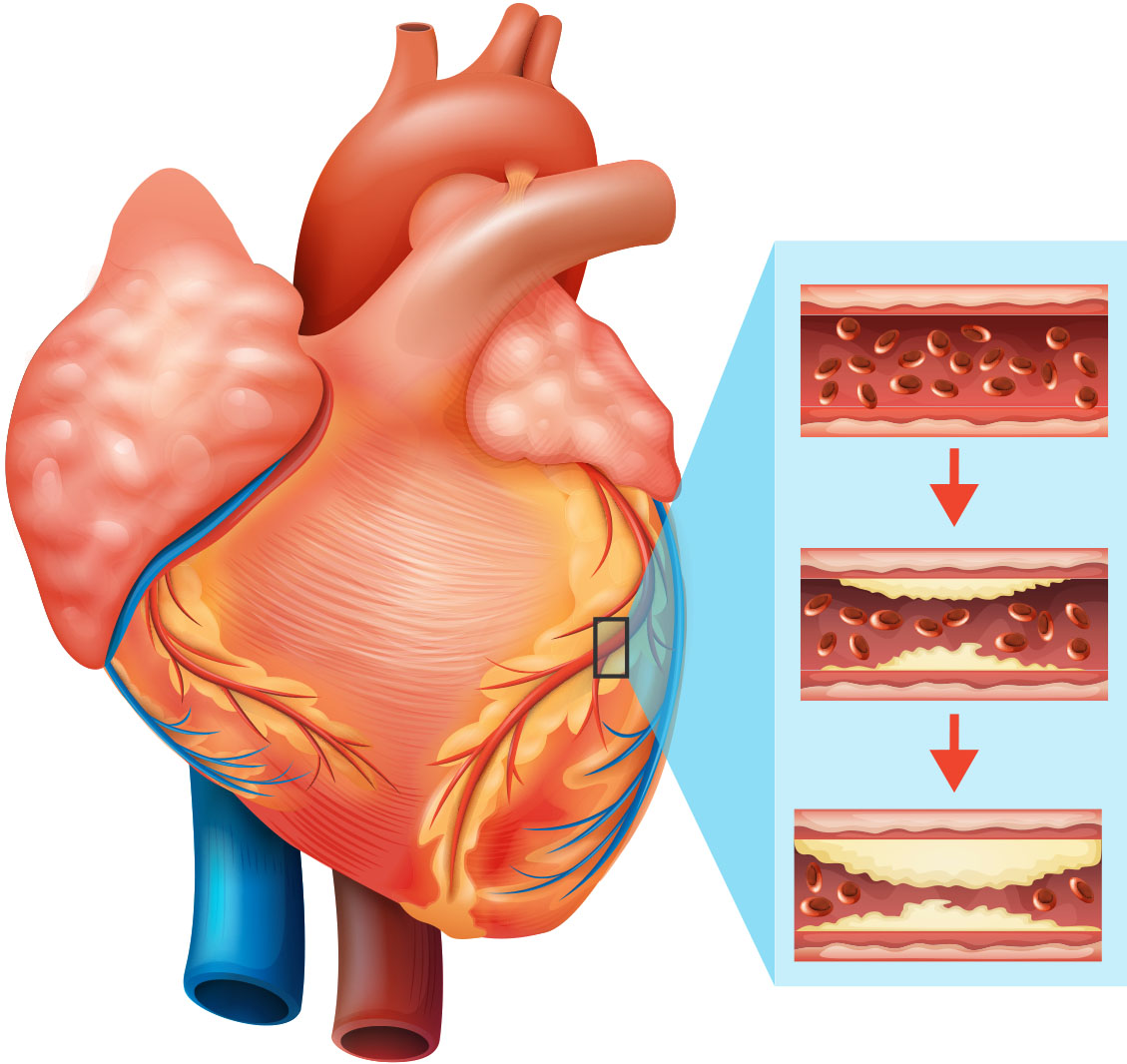 ateroskleroza arterija srca