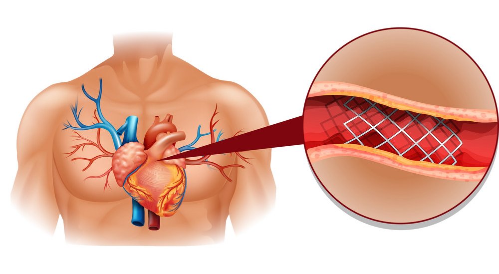 stent i plak u koronarnoj arteriji
