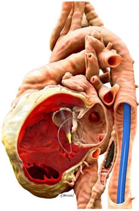 strukturalne bolesti srca