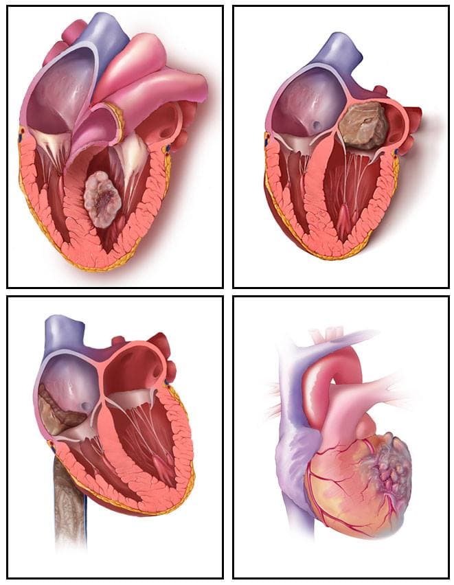 tipovi tumora srca i lokalizacija unutar srca