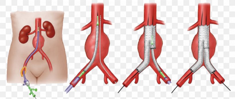abdominal aortic aneurysm endovascular aneurysm repair vascular surgery png favpng FSMD6Hd6pQPS7FQ63n99hk1wP
