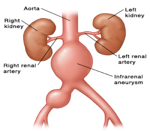 aneurizma abdominalne aorte