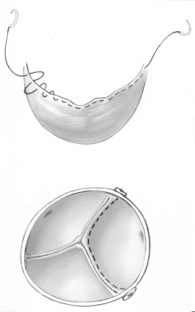 Pojačanje i podizanje slobodnih ivica aortnih kuspisa sa jedinačnom ili dvorednom suturom sa Goratex om 5 0png