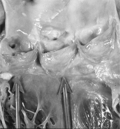 Prikaz izlaznog trakta leve komore i aortnog korena