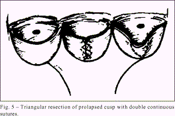 Triangularna resekcija prolabiranog kuspisa