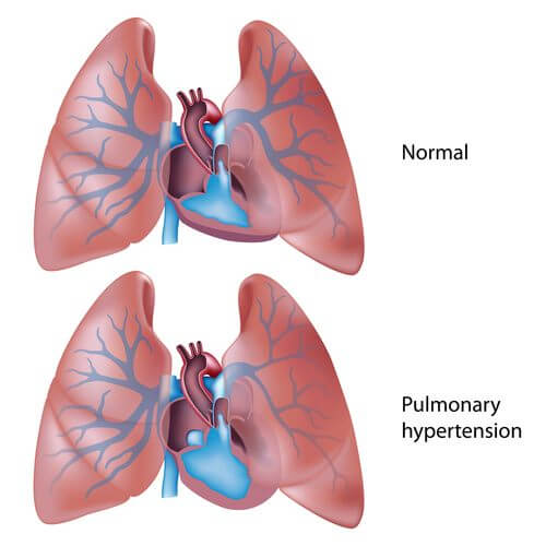 opterecenje desnog srca kod plucne hipertenzije