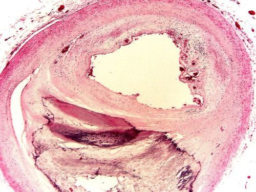Aterosklerotsko suzenje koronarne arterije