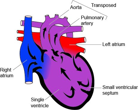 Univentricular Heart1